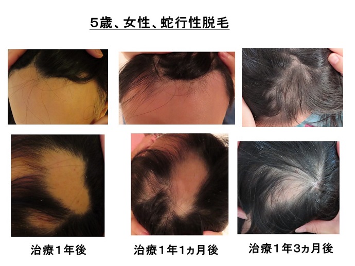 円形脱毛症　病院